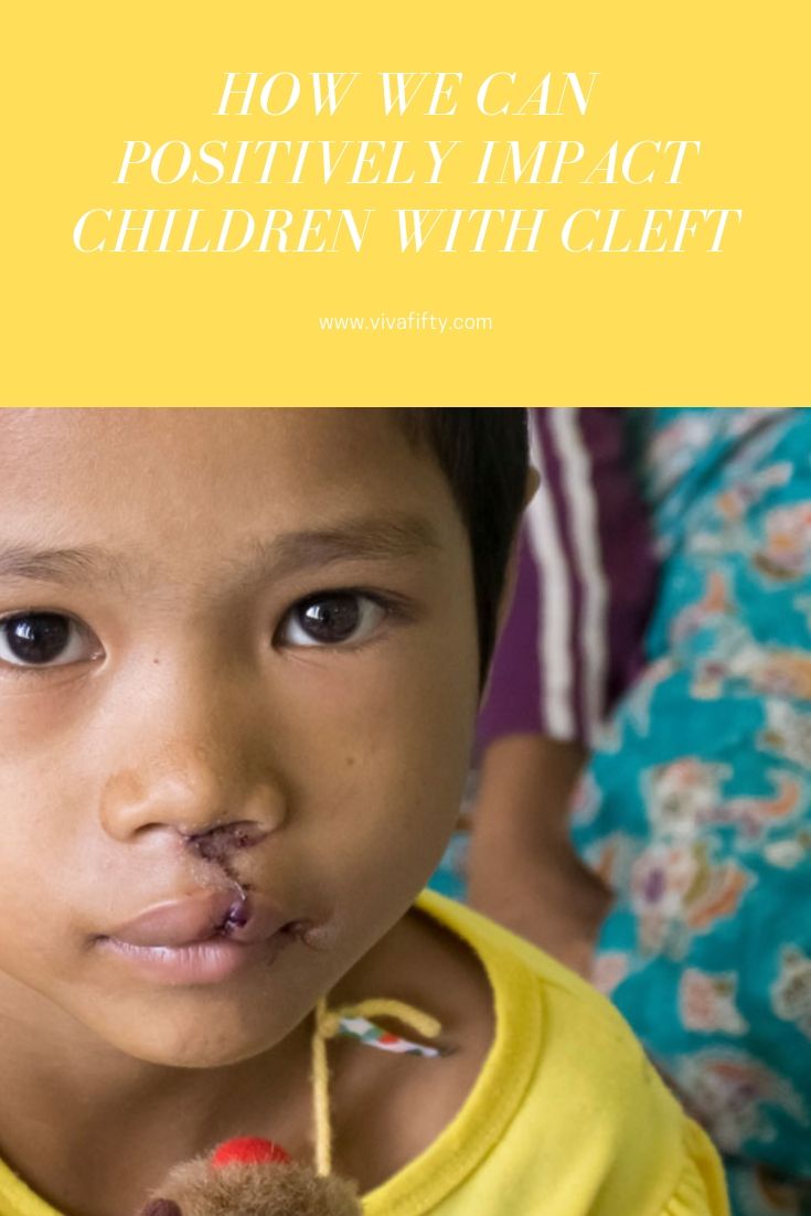 Alliance for Smiles offers children and families with cleft anomalies hope for a bright future. we interviewed Alison Healy, CEO, to find out more. #cleftpalate #cleft #cleftlip